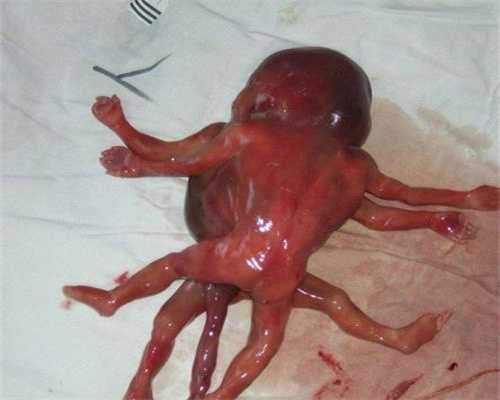 地下代孕市场：准妈妈代孕5个月，发现胎儿长了